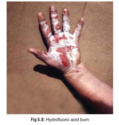 Hydrofluoric Acid - Corrosive(Caustic) Poisons