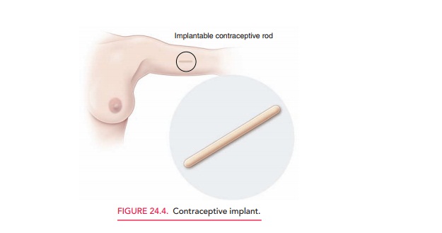Injectable and Implantable Hormonal Contraceptives
