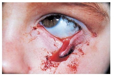 Injuries to the Lacrimal System