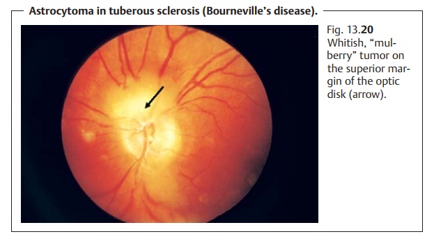 Intraocular Optic Nerve Tumors