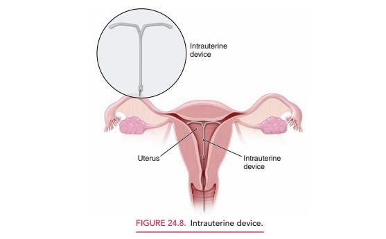 Intrauterine Contraception