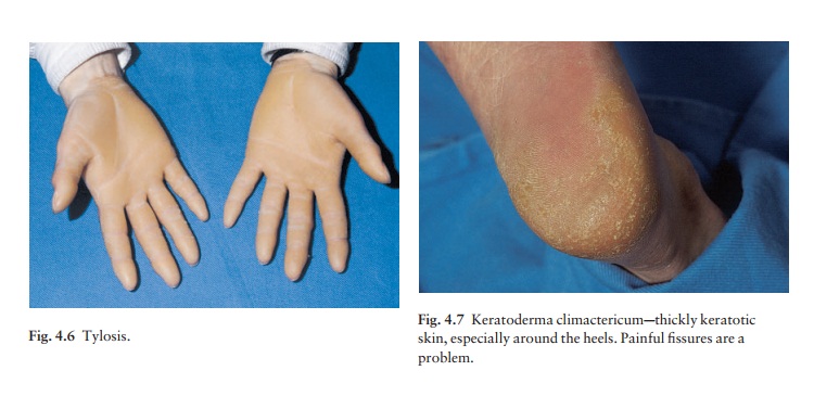 Keratoderma of the palms and soles