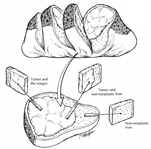 Liver: Surgical Pathology Dissection
