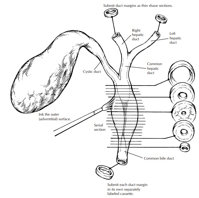 Local or Segmental Biliary Resections: Surgical Pathology Dissection