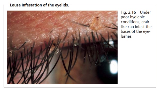 Louse Infestation of the Eyelids
