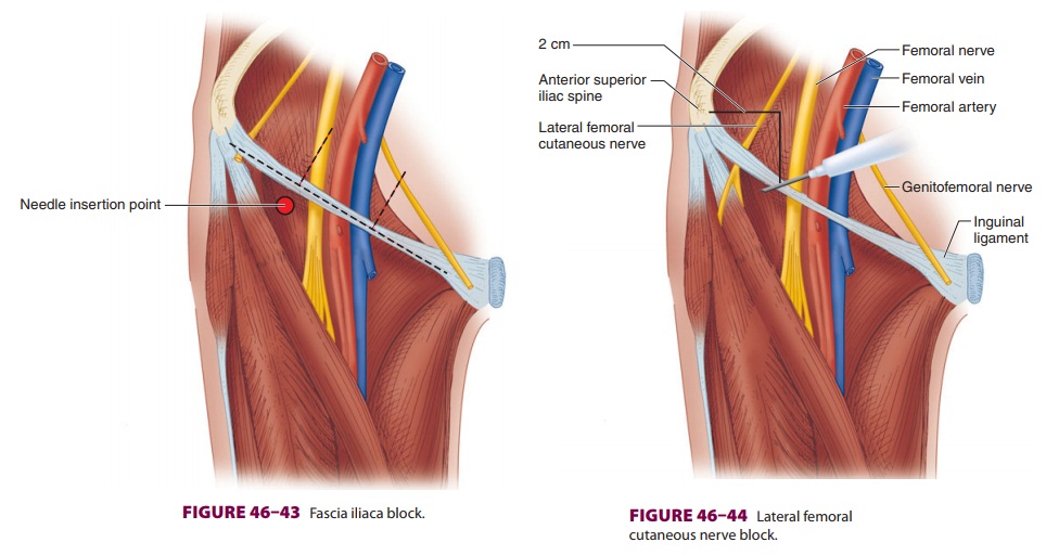 Lower Extremity Peripheral Nerve Blocks: Lateral Femoral Cutaneous Nerve Block
