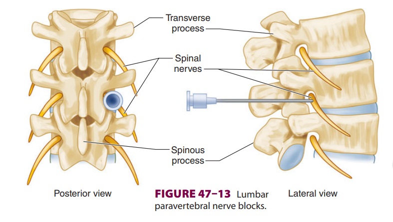 Lumbar Paravertebral Nerve Blocks