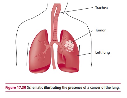 Lung Cancer: Classification, Treatment, Signs, symptoms, diagnosis and staging