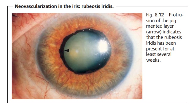 Neovascularization in the Iris: Rubeosis Iridis