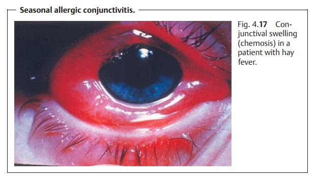 Noninfectious Conjunctivitis
