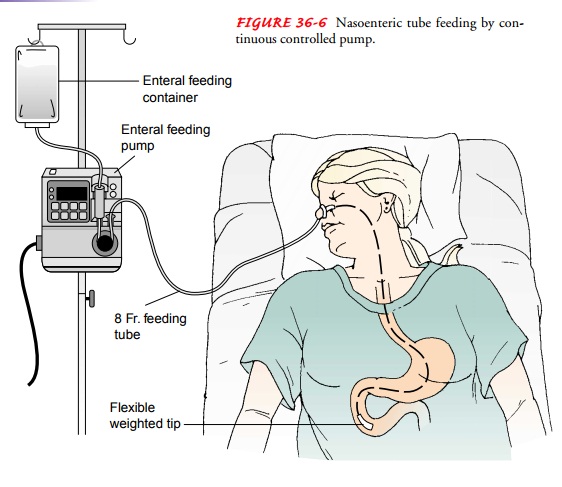 Nursing Process: The Patient Receiving a Tube Feeding