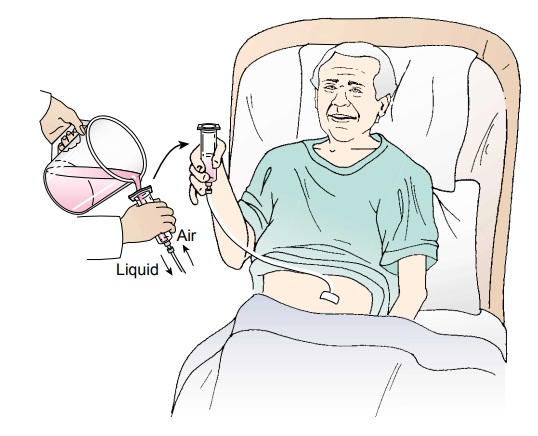 Nursing Process: The Patient With a Gastrostomy
