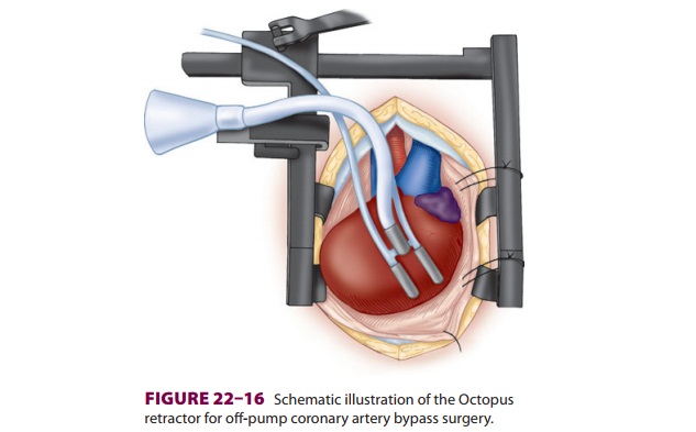 Oﬀ-Pump Coronary Artery Bypass Surgery