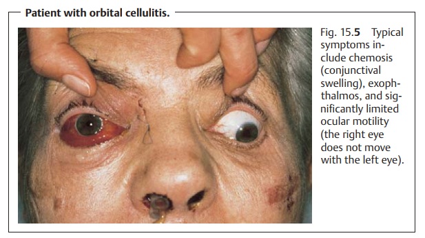 Orbital Cellulitis