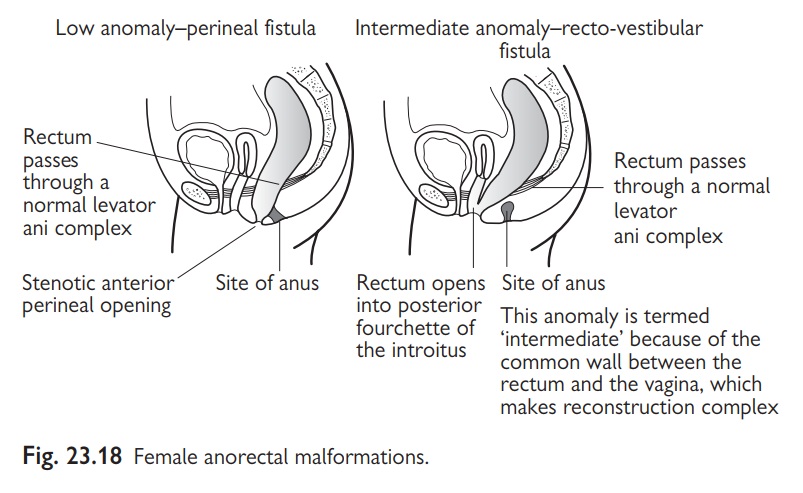 Paediatrics: Anorectal malformations