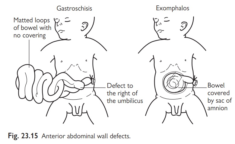 Paediatrics: Exomphalos (omphalocele)