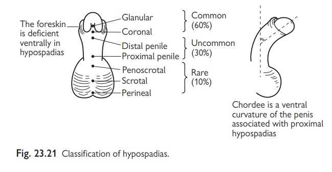 Paediatrics: Hypospadias