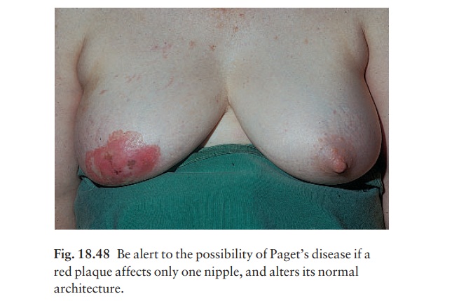 Paget’s disease of the nipple