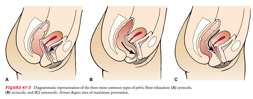 Pelvic Organ Prolapse: Cystocele, Rectocele, Enterocele