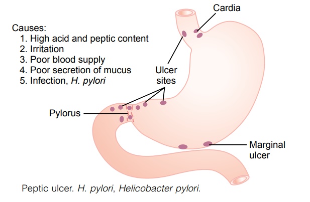Peptic Ulcer - Disorders of the Stomach
