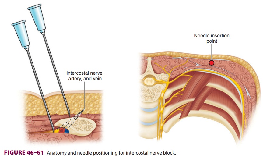 Peripheral Nerve Blocks of the Trunk: Intercostal Block