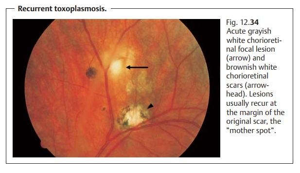 Posterior Uveitis Due to Toxoplasmosis - Retinal Inflammatory Disease