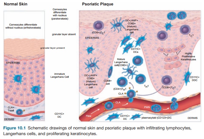 Psoriasis - Skin Diseases