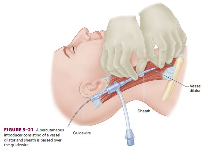Pulmonary Artery Catheterization