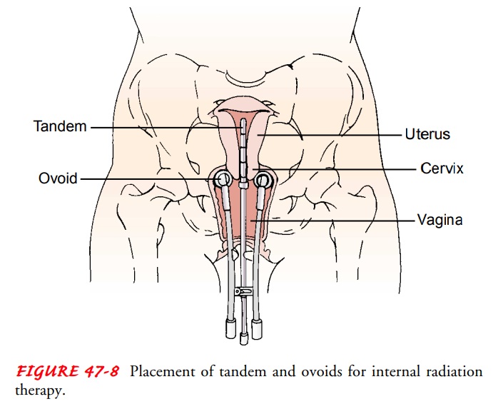 Radiation Therapy - Female Reproductive System