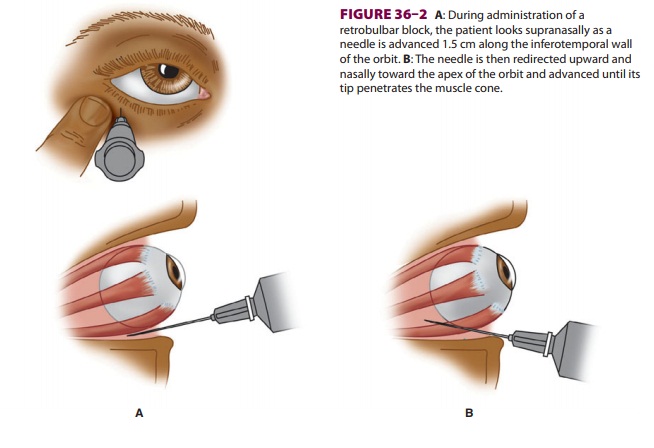 Regional Anesthesia for Ophthalmic Surgery