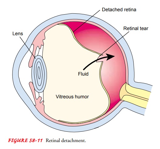 Retinal Detachment - Retinal Disorders