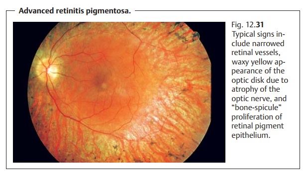Retinal Dystrophies: Retinitis Pigmentosa