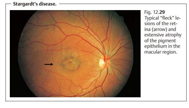 Retinal Dystrophies: Macular Dystrophies