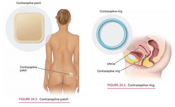 Ring and Patch - Contraception
