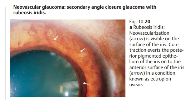 Secondary Angle Closure Glaucoma