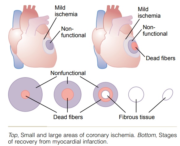 Stages of Recovery from Acute Myocardial Infarction