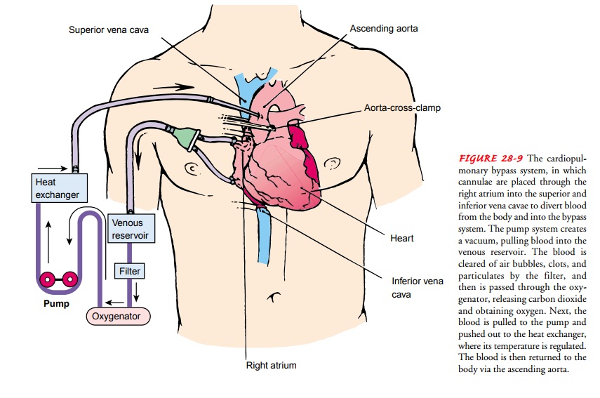 Surgical Procedures - Invasive Coronary Artery Procedures