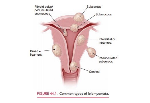 Symptoms of Uterine Leiomyomas