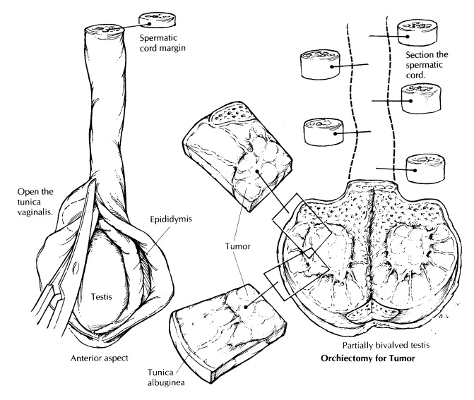 Testis : Surgical Pathology Dissection