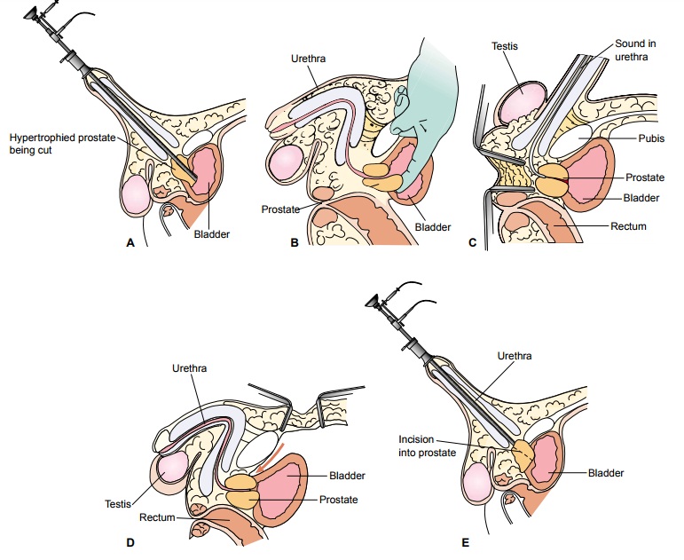 The Patient Undergoing Prostate Surgery