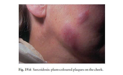 The skin in sarcoidosis