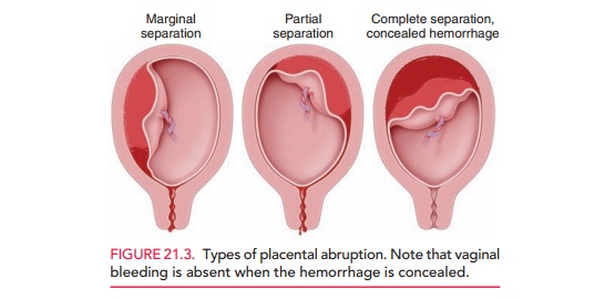 Third-Trimester Bleeding: Placental Abruption