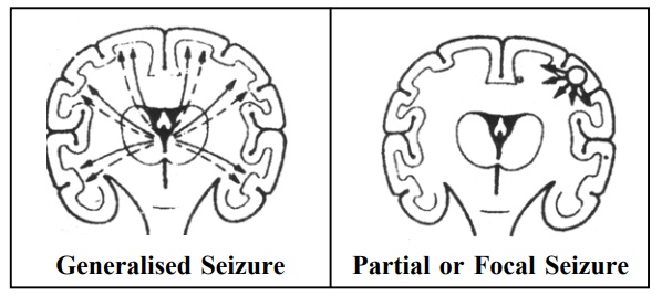 Three types of epilepsy