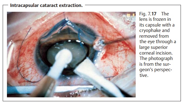Treatment of Cataracts