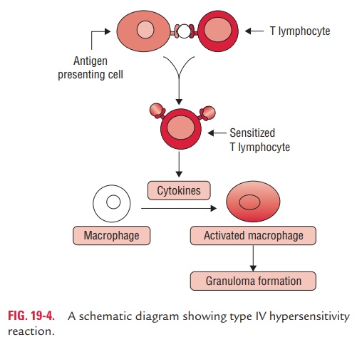 Type IV Delayed (Cell-Mediated) Hypersensitivity