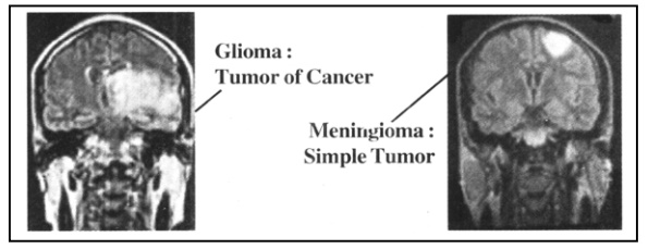 Types of Brain tumors