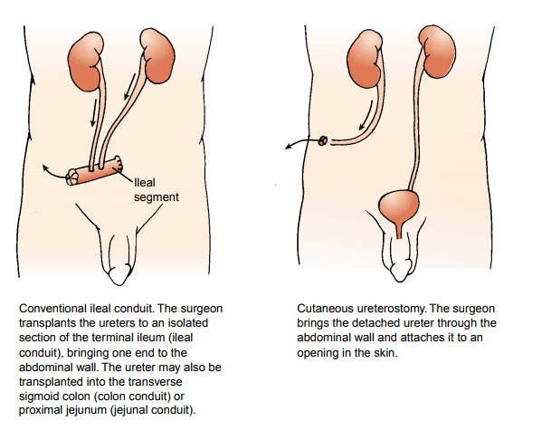 Urinary Diversions