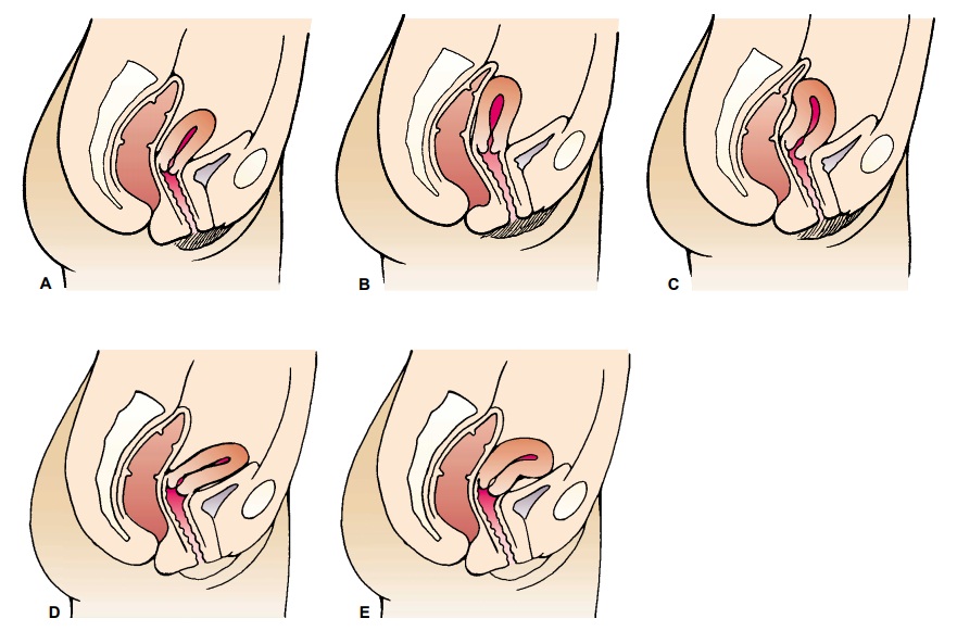 Uterine Prolapse - Structural Disorders