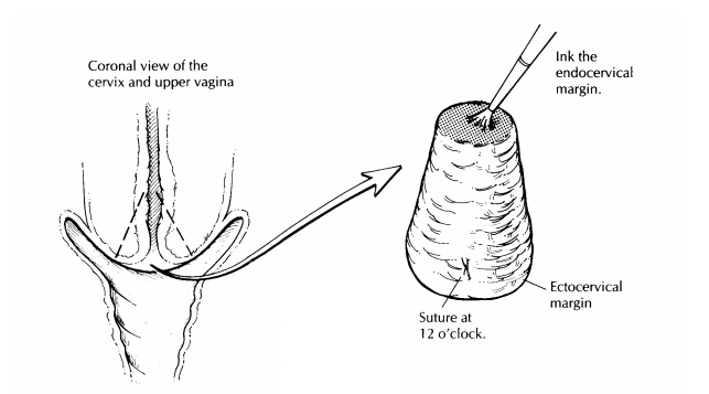 Uterus : Surgical Pathology Dissection