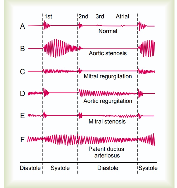 Valvular Lesions - Heart Sounds